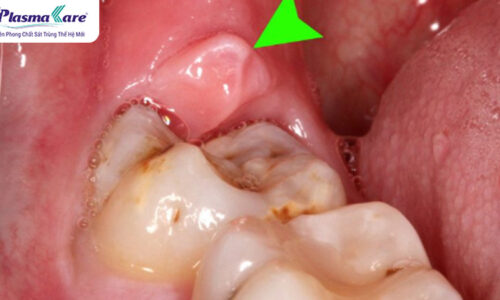 Hình ảnh viêm lợi trùm răng số 8: cách chữa trị bằng thuốc và dân gian