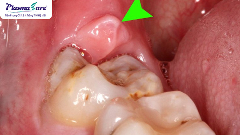 Hình ảnh viêm lợi trùm răng số 8: cách chữa trị bằng thuốc và dân gian