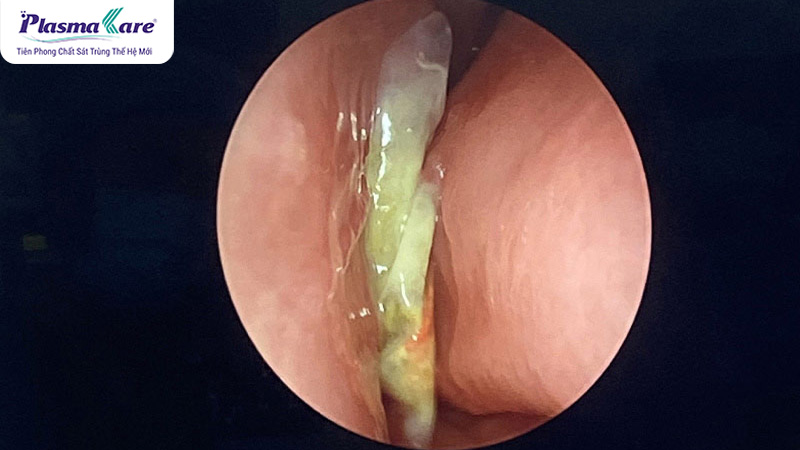 Nguyên nhân trẻ bị nghẹt mũi nhưng không chảy nước mũi và cách xử lý