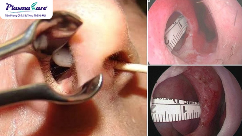 Nguyên nhân trẻ bị nghẹt mũi nhưng không chảy nước mũi và cách xử lý