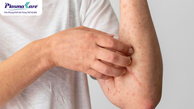 Vì sao muỗi đốt lại ngứa? Và lý do ngứa nhiều ngày không khỏi