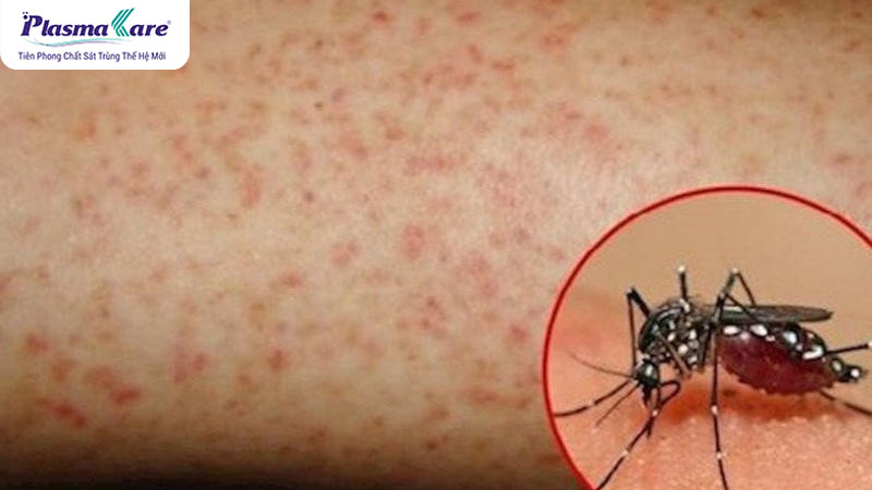 Vì sao muỗi đốt lại ngứa? Và lý do ngứa nhiều ngày không khỏi