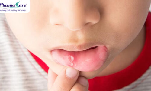 Bé thường xuyên bị nhiệt miệng là thiếu vitamin gì? Cách xử lý nhanh hết Bé thường xuyên bị nhiệt miệng là thiếu vitamin gì? Cách xử lý nhanh hết