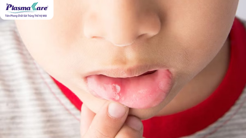 Bé thường xuyên bị nhiệt miệng là thiếu vitamin gì? Cách xử lý nhanh hết