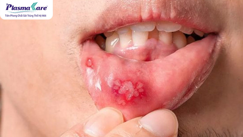 Bị nhiệt miệng uống gì nhanh khỏi và giảm đau hiệu quả?