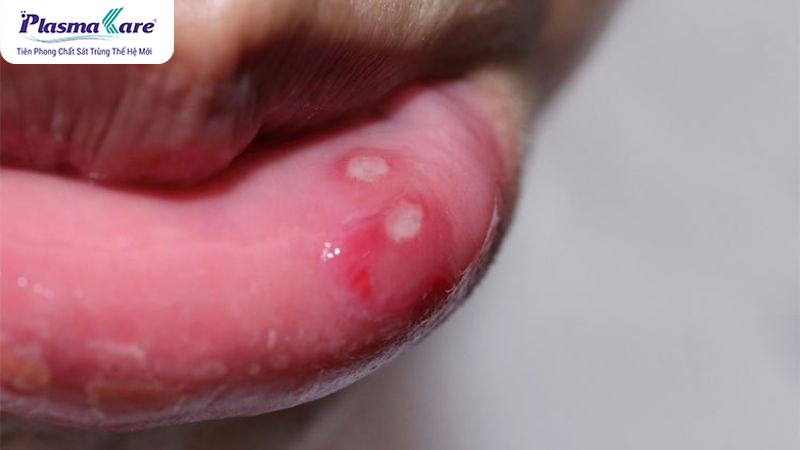 Nhiệt miệng uống vitamin gì? 6 loại vitamin giúp giảm nhiệt miệng nhanh