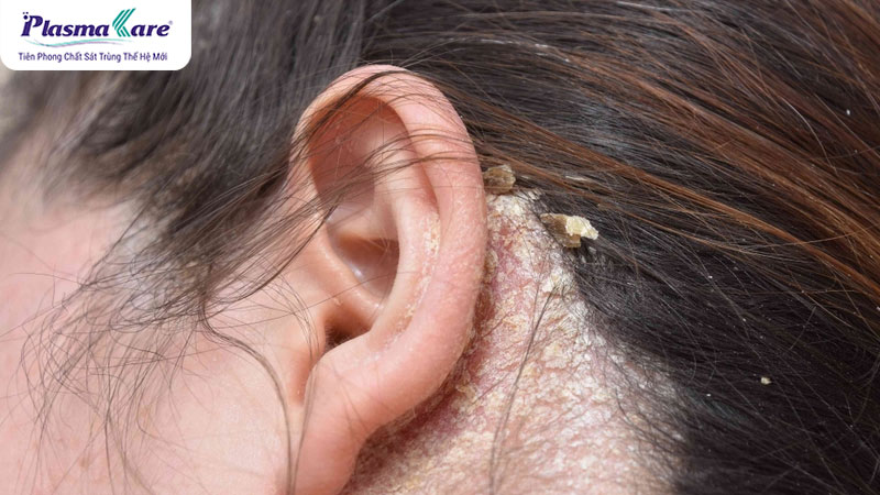 Viêm da tiết bã bôi gì? 5 loại thuốc bôi viêm da tiết bã an toàn, hiệu quả nhất