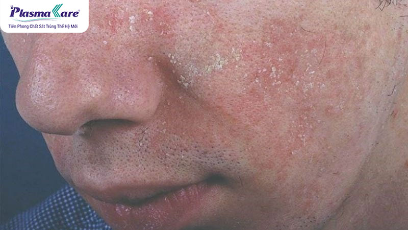 Viêm da tiết bã bôi gì? 5 loại thuốc bôi viêm da tiết bã an toàn, hiệu quả nhất