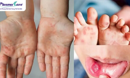 6 cách phòng bệnh tay chân miệng hiệu quả, cha mẹ cần biết