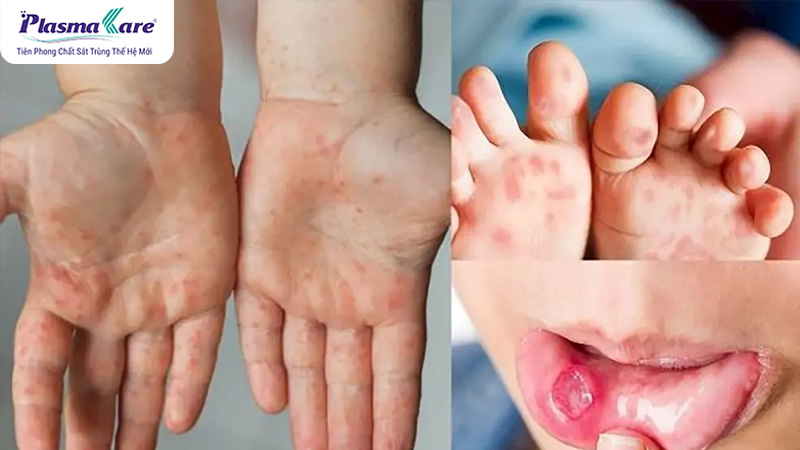 6 cách phòng bệnh tay chân miệng hiệu quả, cha mẹ cần biết