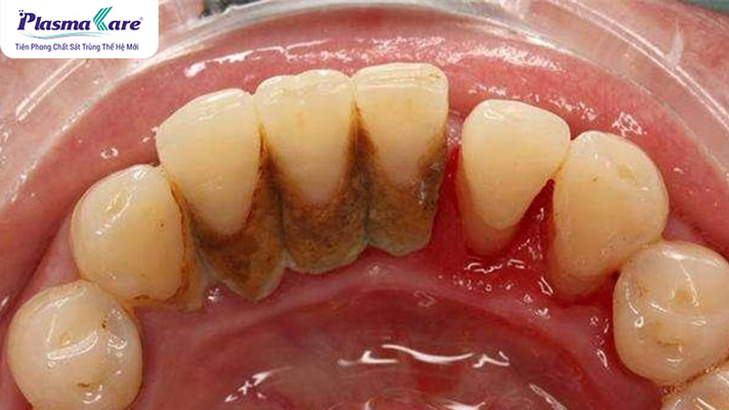 Cao răng là gì? Nguyên nhân hình thành và phân độ cao răng