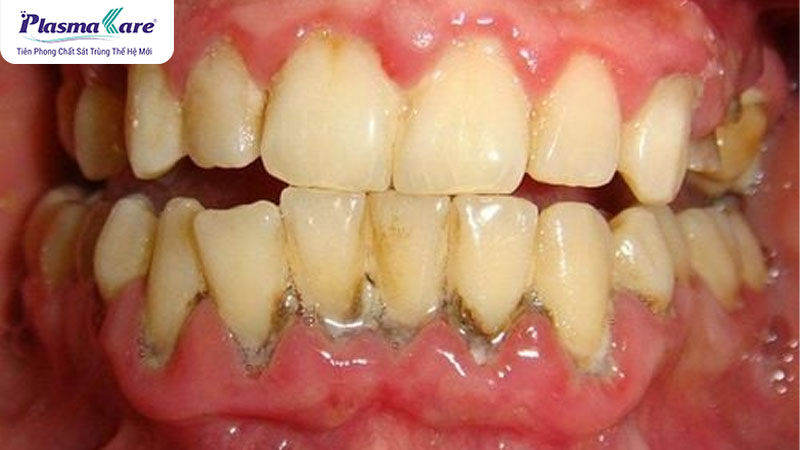 Cao răng là gì? Nguyên nhân hình thành và phân độ cao răng