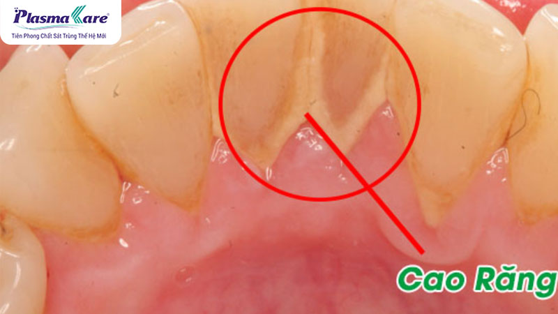 Cao răng là gì? Nguyên nhân hình thành và phân độ cao răng