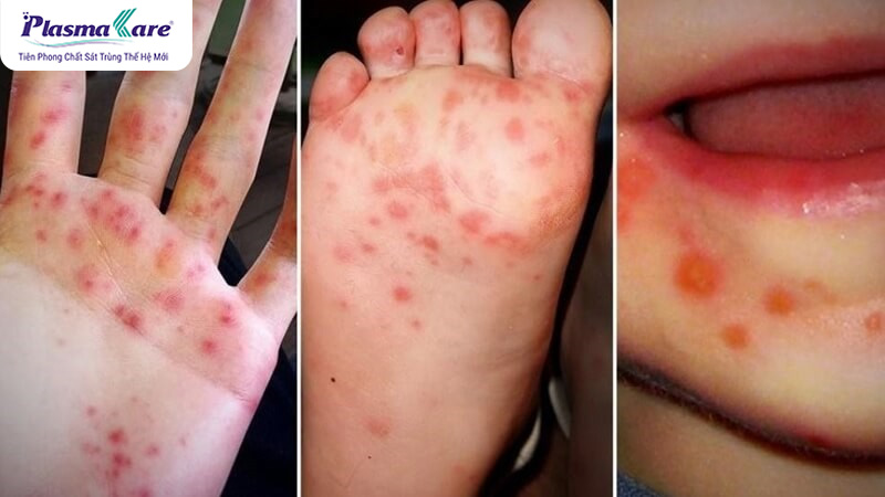 Hướng dẫn cách xử lý và chăm sóc bé bị tay chân miệng tại nhà
