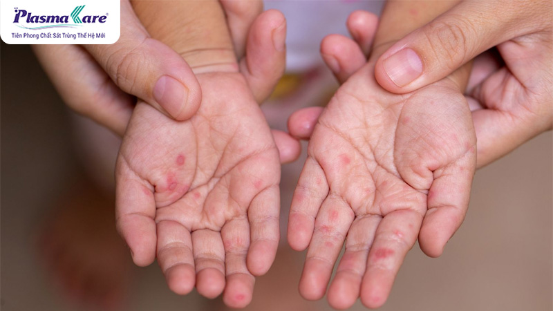 Hướng dẫn cách xử lý và chăm sóc bé bị tay chân miệng tại nhà