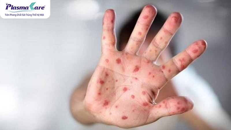 Những phương pháp điều trị tay chân miệng phổ biến hiện nay