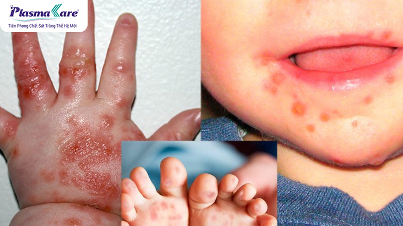 Những phương pháp điều trị tay chân miệng phổ biến hiện nay
