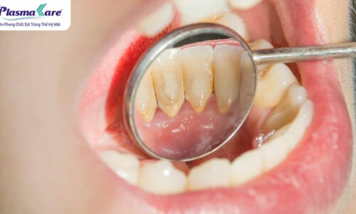 Hướng dẫn lấy cao răng tại nhà đơn giản, an toàn và sạch sẽ Hướng dẫn lấy cao răng tại nhà đơn giản, an toàn và sạch sẽ