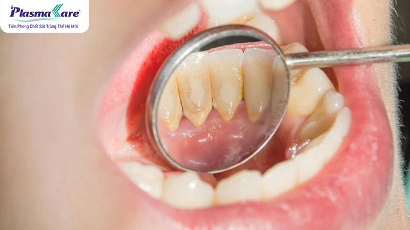 Hướng dẫn lấy cao răng tại nhà đơn giản, an toàn và sạch sẽ