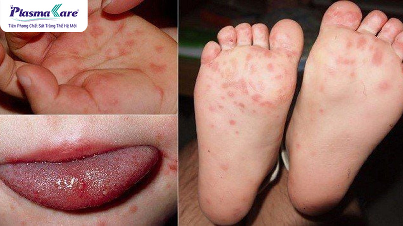 Mách mẹ cách nhanh hết tay chân miệng ở trẻ nhỏ