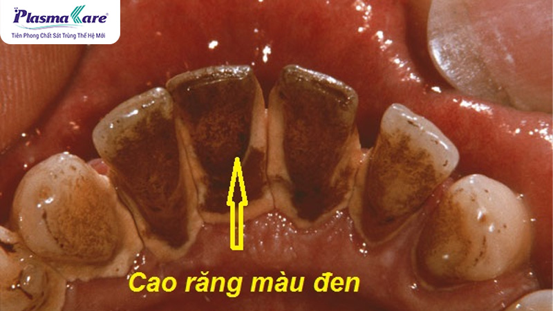 Cao răng màu đen là gì? Nguyên nhân và cách xử lý cao răng màu đen