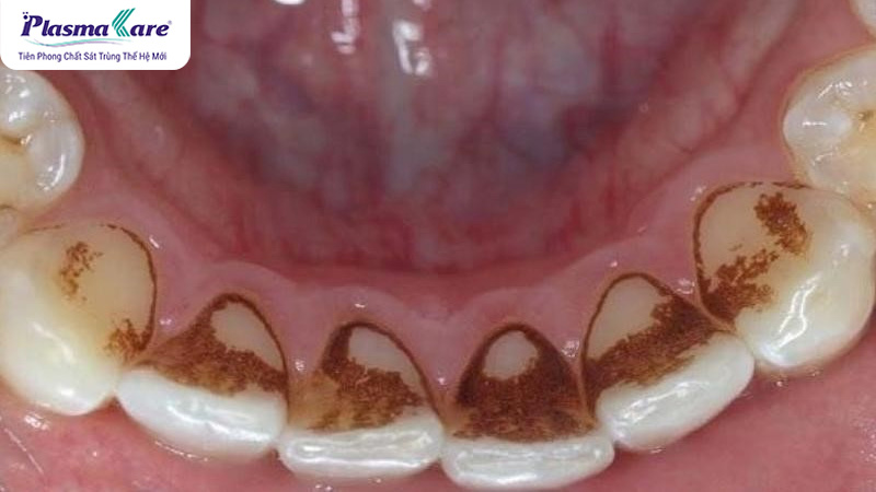 Cao răng màu đen là gì? Nguyên nhân và cách xử lý cao răng màu đen