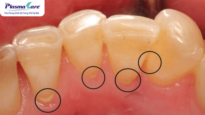 Cao răng tự rơi ra có tốt không? Nguyên nhân và 1 số lưu ý