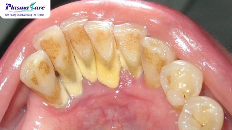 Cao răng tự rơi ra có tốt không? Nguyên nhân và 1 số lưu ý