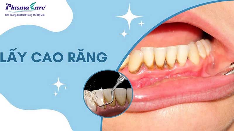 Tham khảo bảng giá chi phí lấy cao răng cập nhật 2026