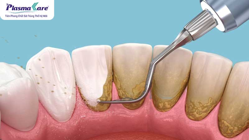 Tham khảo bảng giá chi phí lấy cao răng cập nhật 2026
