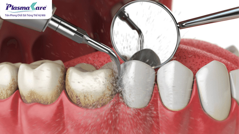 Lấy cao răng có trắng răng không? Lấy cao răng và tẩy trắng cùng lúc được không?