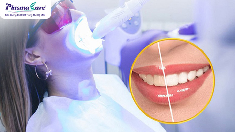 Lấy cao răng có trắng răng không? Lấy cao răng và tẩy trắng cùng lúc được không?