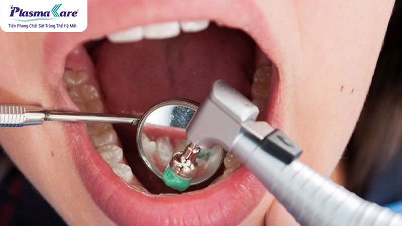 Có nên lấy cao răng không? Một số lưu ý khi lấy cao răng