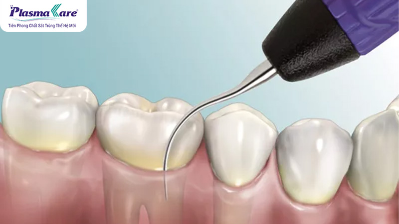 Lấy cao răng có đau không? Cần lưu ý gì?