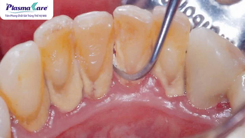 Có nên lấy cao răng không? Một số lưu ý khi lấy cao răng