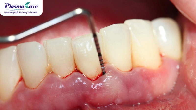 Lấy cao răng có tốt không? Có lợi hay có hại?