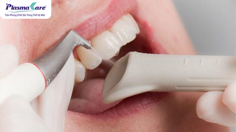 Lấy cao răng có lâu không? Sau khi lấy cao răng bao lâu thì được ăn?