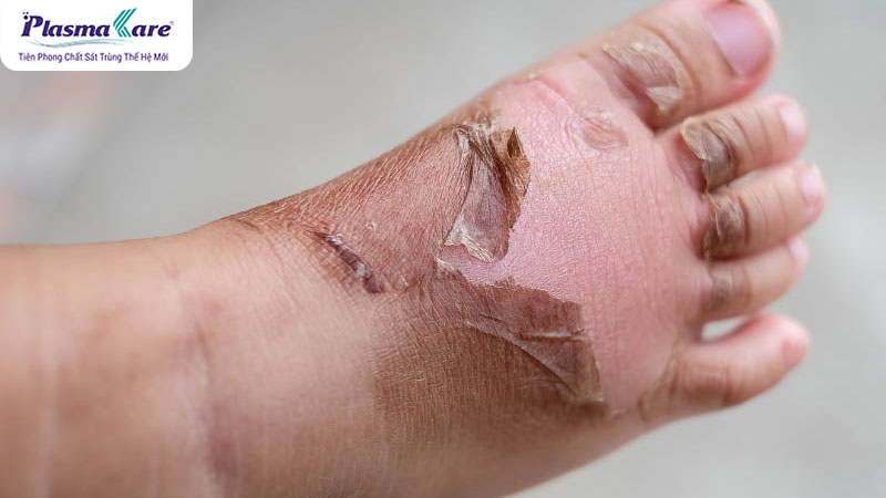 Mách mẹ cách điều trị và chăm sóc bé bị phỏng bô xe máy