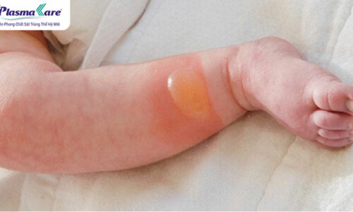 Mách mẹ cách điều trị và chăm sóc bé bị phỏng bô xe máy