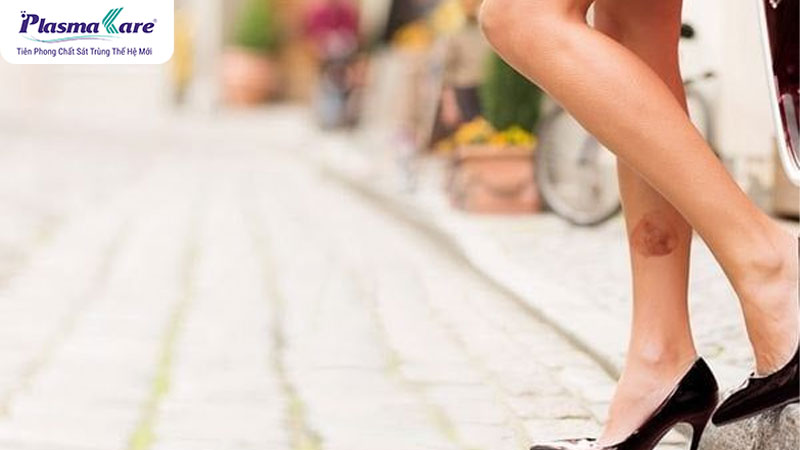 Bị bỏng bô có để lại sẹo không? Mách bạn cách điều trị hiệu quả nhất