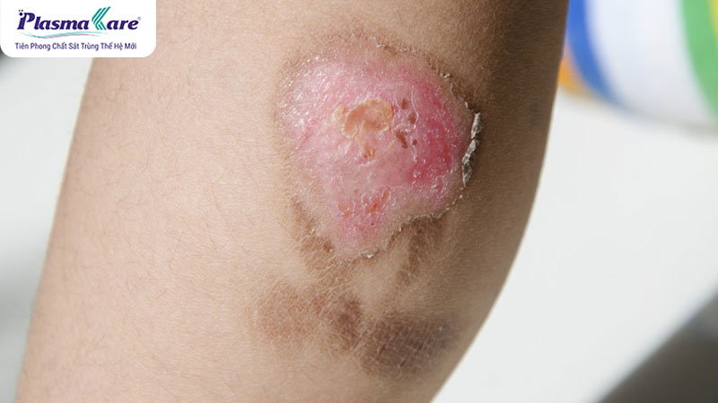 Bỏng bô xe máy: Nguyên nhân, tác hại và cách phòng tránh