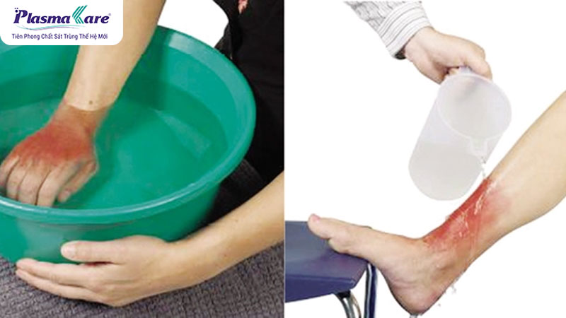 Bỏng bô xe máy: Nguyên nhân, tác hại và cách phòng tránh