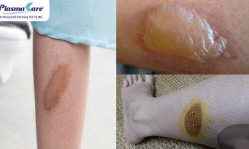 Bỏng bô xe máy: Nguyên nhân, tác hại và cách phòng tránh