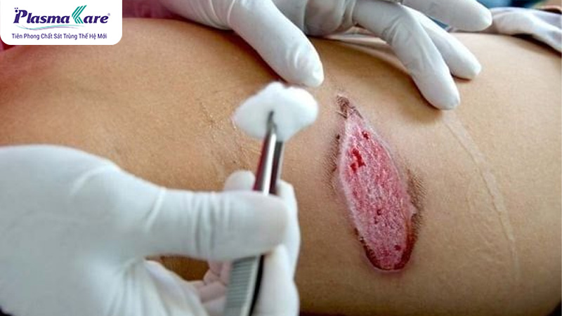 Cách xử lý bỏng bô xe máy bị phồng nước, vỡ và chảy nước vàng