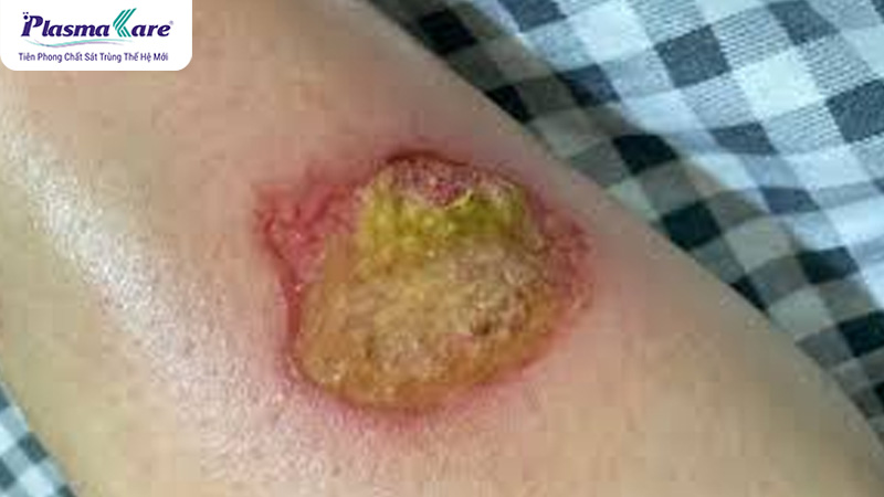 Cách xử lý bỏng bô xe máy bị phồng nước, vỡ và chảy nước vàng