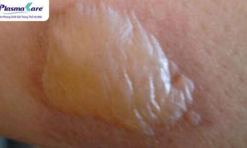 Cách xử lý bỏng bô xe máy bị phồng nước, vỡ và chảy nước vàng