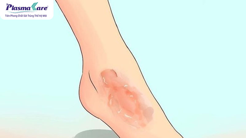 Bị bỏng bô xe máy nên bôi gì nhanh khỏi và không để lại sẹo