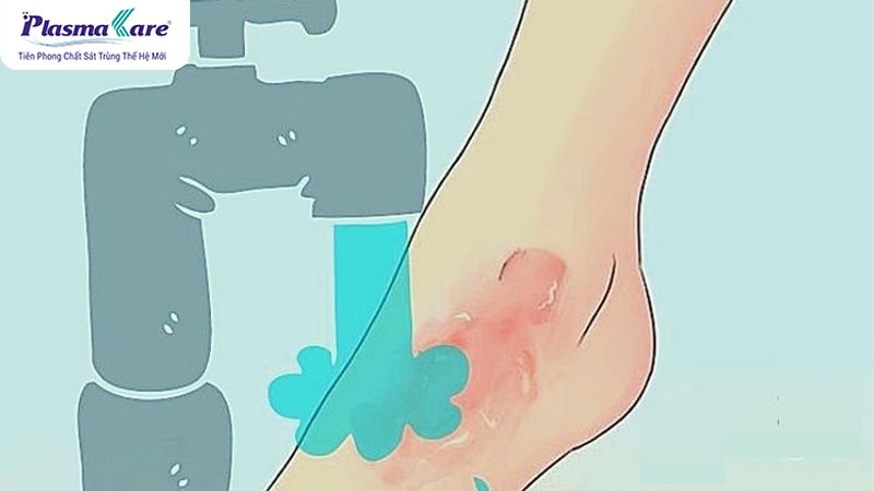 Bị bỏng bô xe máy nên bôi gì nhanh khỏi và không để lại sẹo