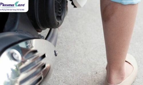 Bị bỏng bô xe máy nên bôi gì nhanh khỏi và không để lại sẹo
