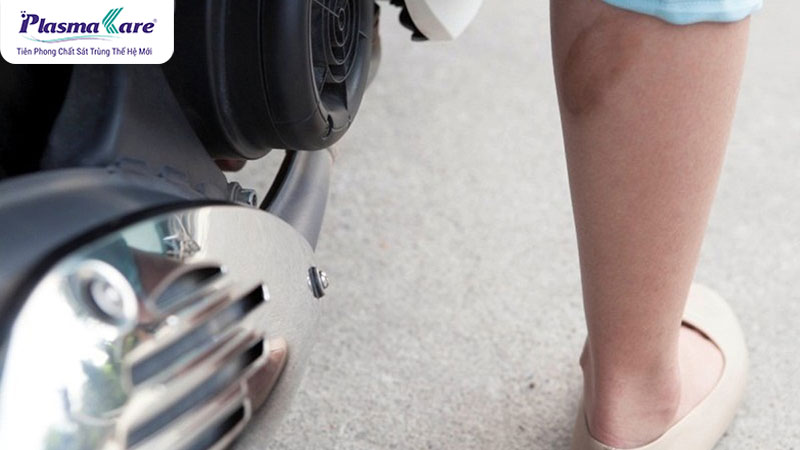 Bị bỏng bô xe máy nên bôi gì nhanh khỏi và không để lại sẹo